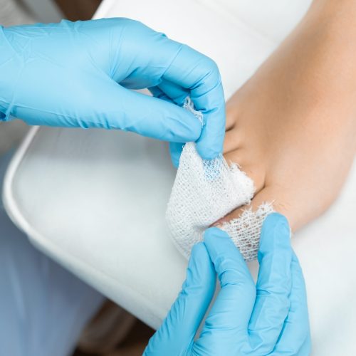 Podologist uses a bandage to apply antiseptic to the toe after nail removal.